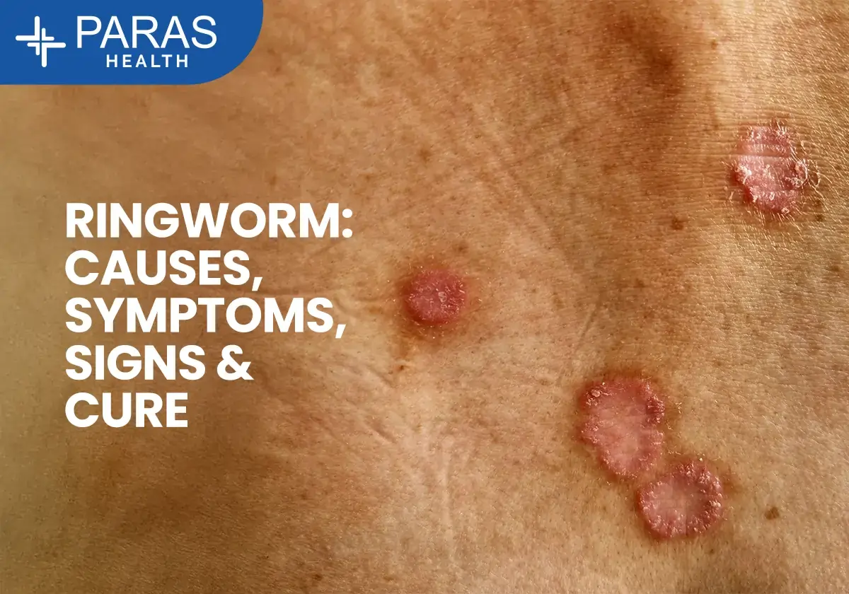 Ringworm Infection